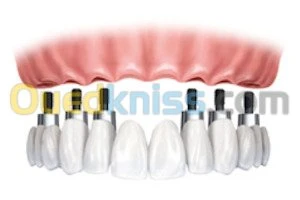 Implant dentaire et chirurgie buccale