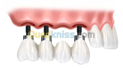 Implant dentaire et chirurgie buccale