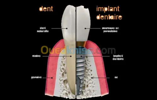 Implant dentaire et chirurgie buccale