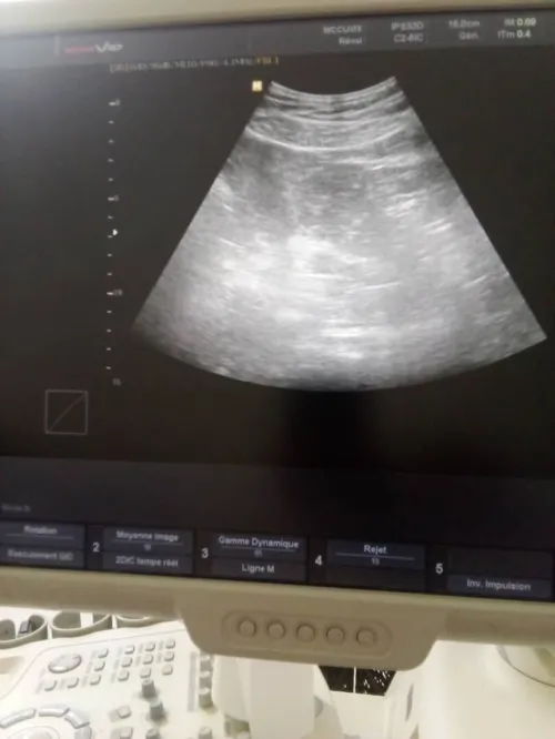 Echographe  medison ACCUVIX V10