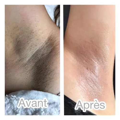 Esthétique rajeunissement réparation détatouge