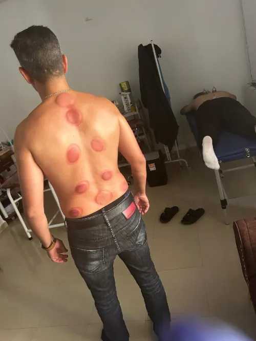 حجامة دموية و جافة ، مساج hijama, massage