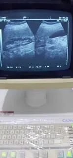 Vente échographe Toshiba avec imprimante