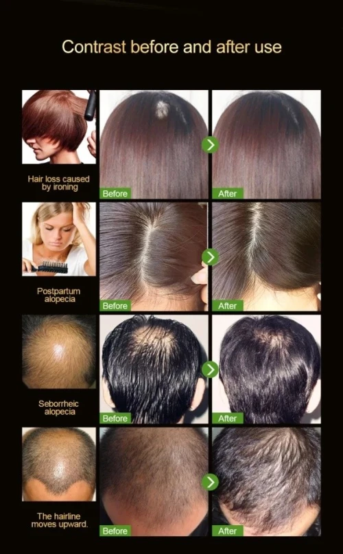 Anti chute cheveux solution miracle تساقط الشعر