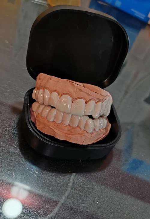 Snap on smile