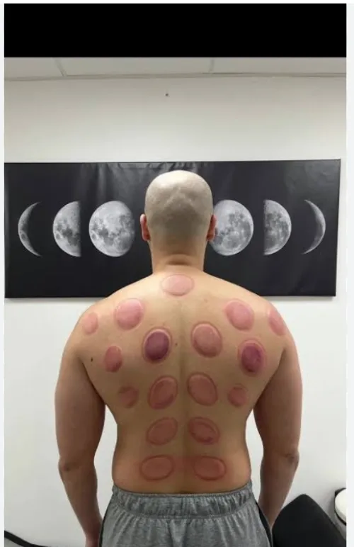 Hidjama médicale 